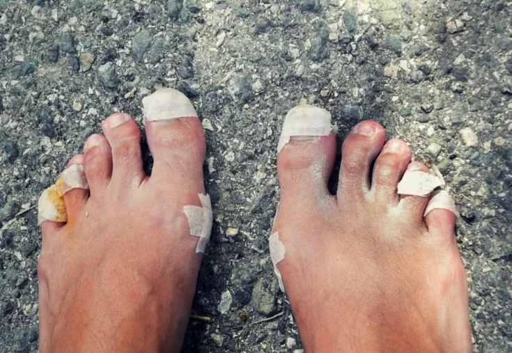 How to Prevent and Treat Blisters When Hiking | Hiking tips, Hiking ...