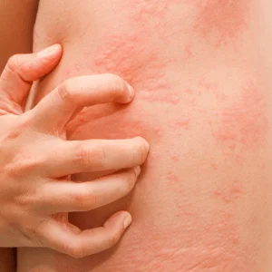 What Is Chronic Spontaneous Urticaria (CSU)? Experts Break Down What You Need to Know